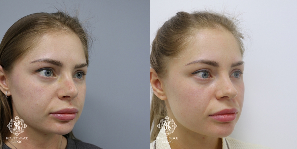 ринопластика Ольга Носова