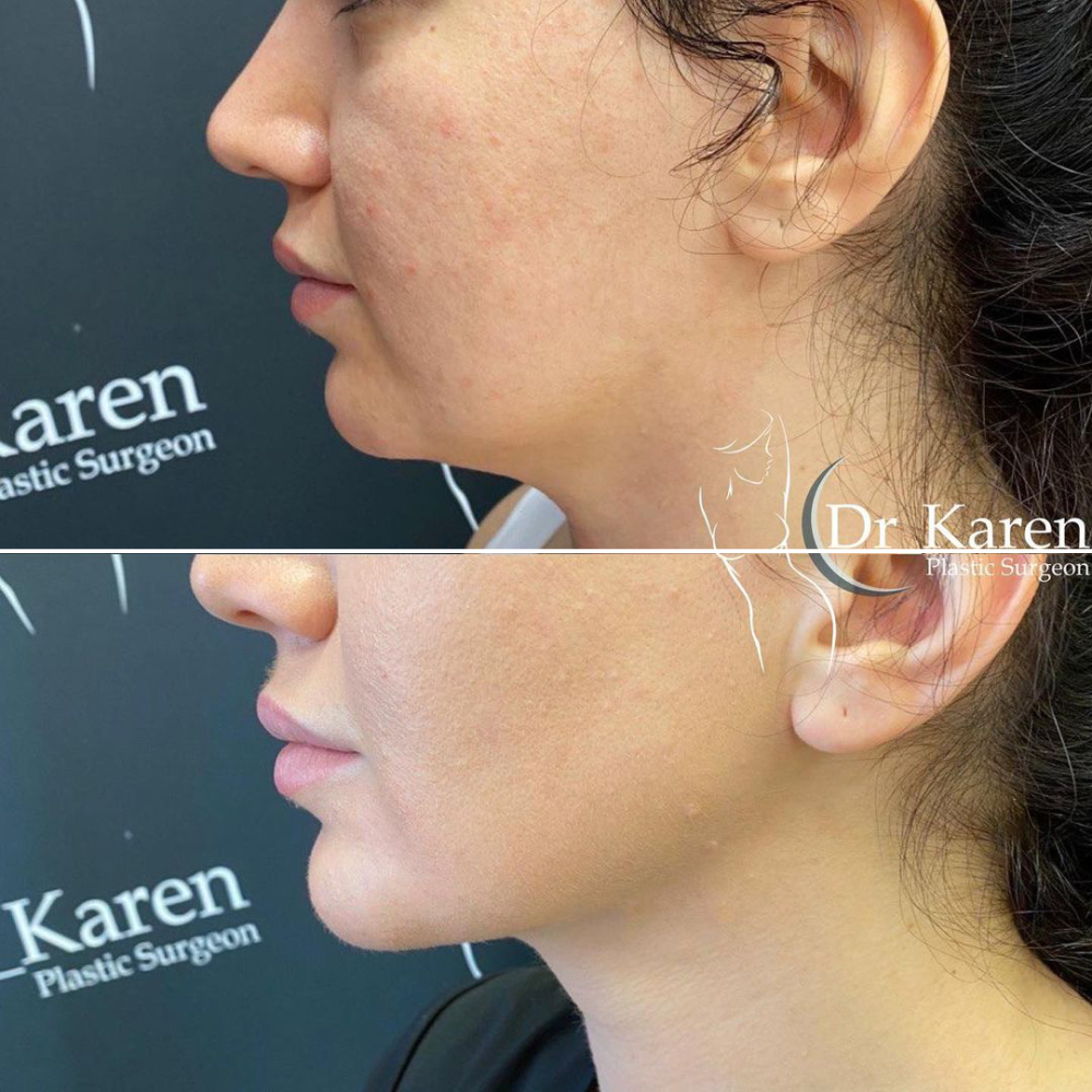 Удаление комков биша Карен Пайтян