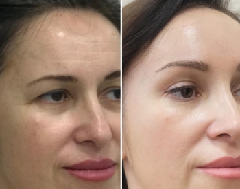 Визаж Лифт подтяжка без швов