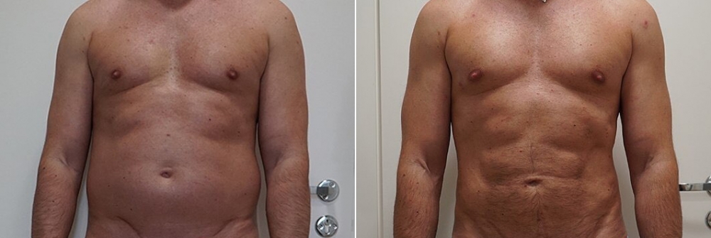 VASER-липосакция высокой четкости передней брюшной