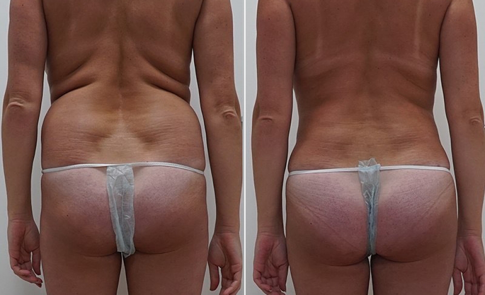 VASER + радиочастотная обработка Body Tite.