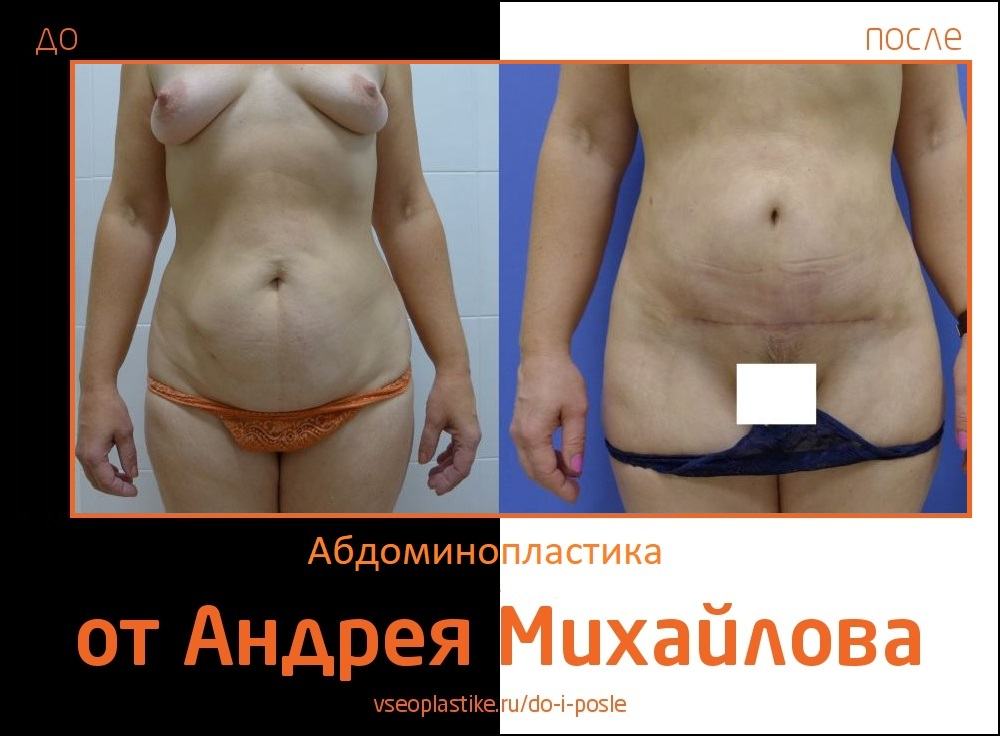  Фото до и после абдоминопластики у доктора Михайлова