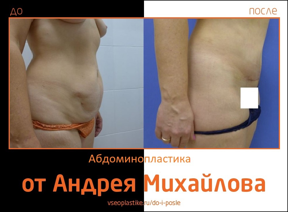 Андрей Михайлов. Фото до и после абдоминопластики
