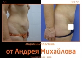 Андрей Михайлов. Фото до и после абдоминопластики