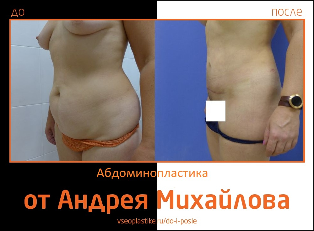  Фото пациентки до и после абдоминопластики у доктора Михайлова
