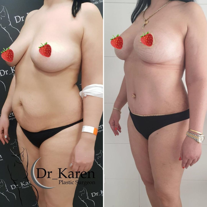 Пациентка доктора Пайтяна после пластики Постнатал