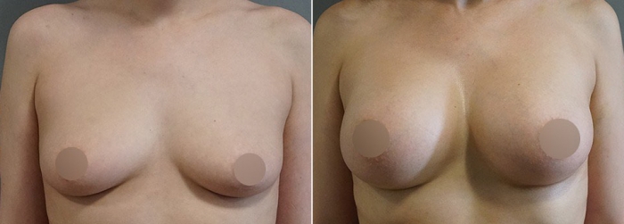 Пенаев грудь до и после увеличения