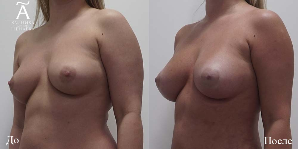 Пациентка пластического хирурга Арслана Пенаева. Фото до и после липофилинга груди