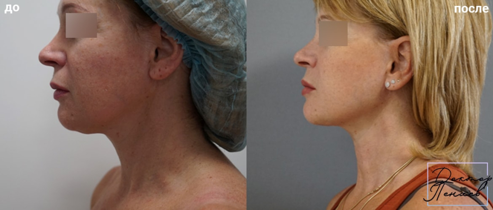 Пациентка доктора Пенаева до и после нитевого лифтинга лица