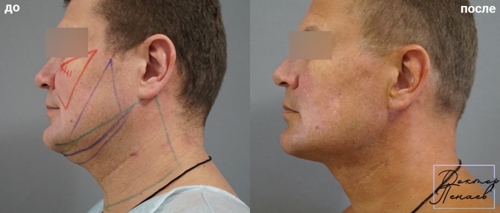 Пациент профессора Арслана Пенаева до и после мультитехнологичной пластики лица