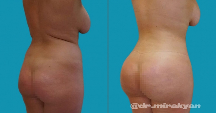 Пациентка доктора Гукаса Миракяна до и после липофилинга груди