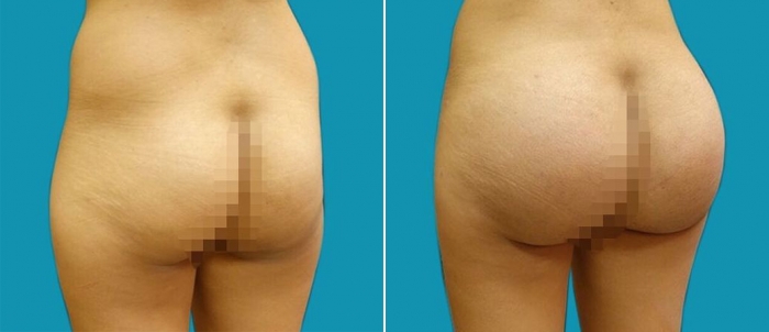 Увеличение ягодиц имплантами Гукас Миракян