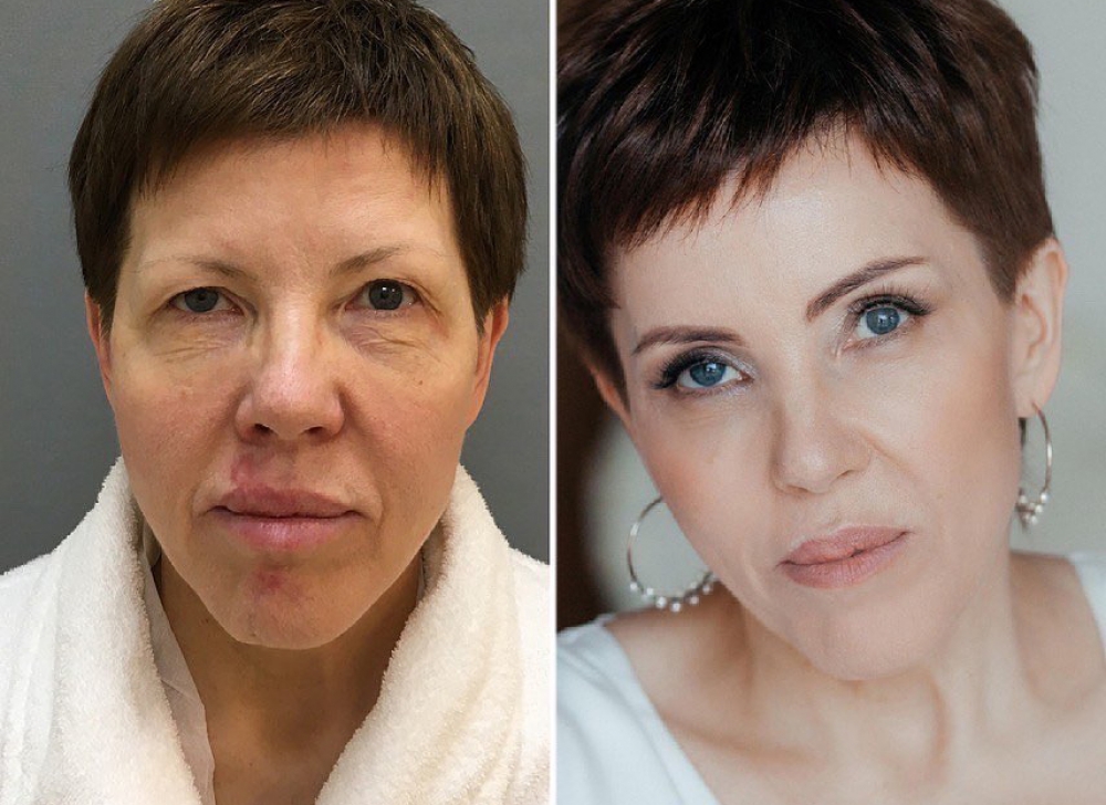 подтяжка лица Марина Четверикова