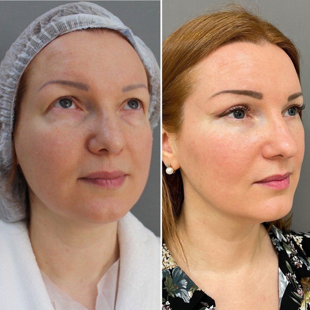 Эндоскопическая подтяжка и верхняя блефаропластика