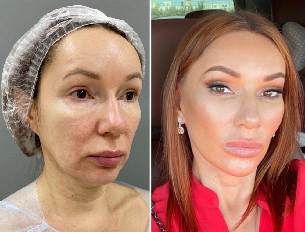 Марина Четверикова комплексное омоложение лица