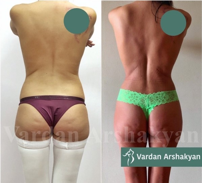 Пациентка доктора Аршакяна до и после операции по сужению талии