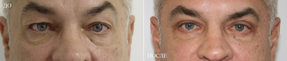 Пациент доктора Арслана Пенаева до и после круговой блефаропластики