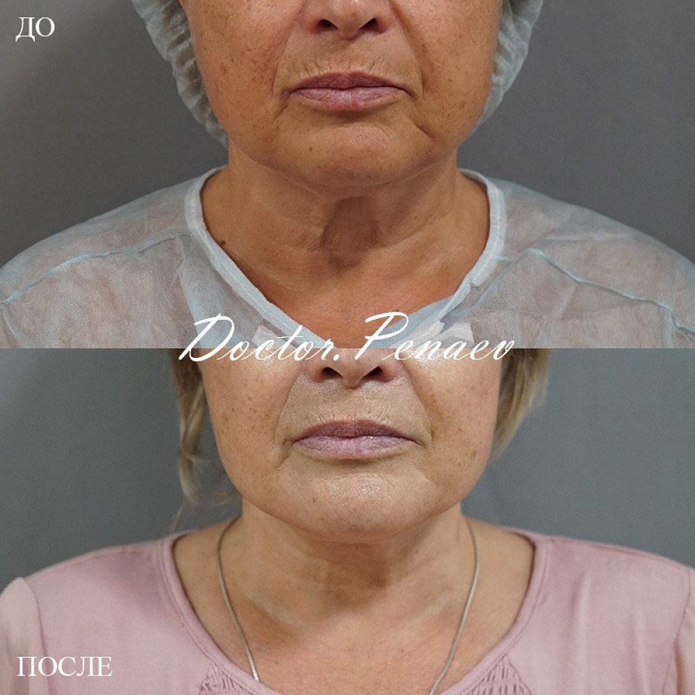 Пациентка доктора Арслана Пенаева до и после омоложения лица и шеи