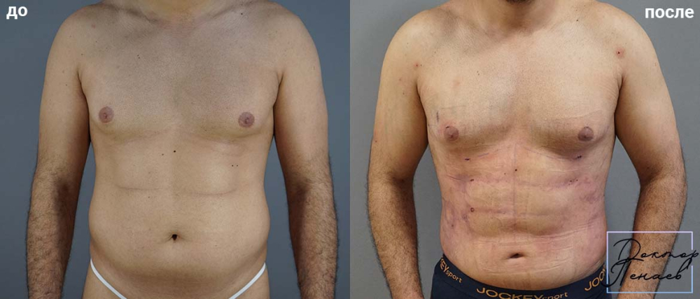 Пациент доктора Арслана Пенаева до и после Vaser-липосакции тела