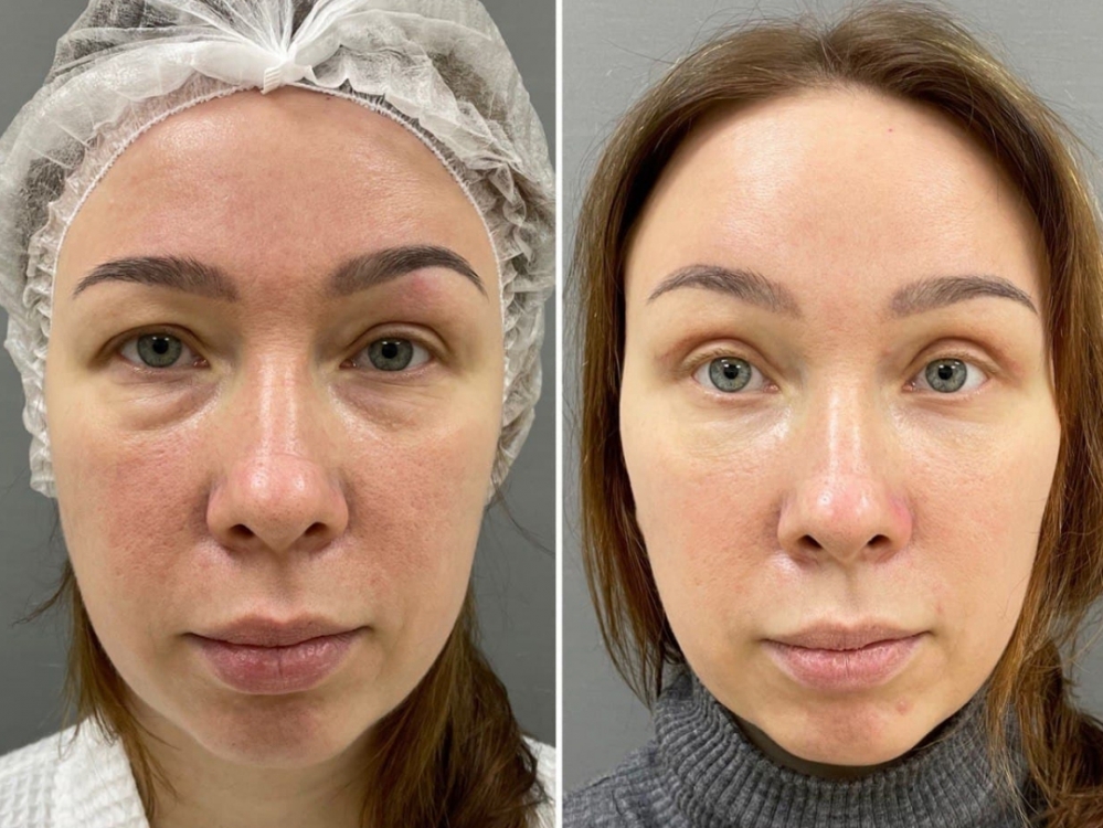 Периорбитопластика и блефаропластика