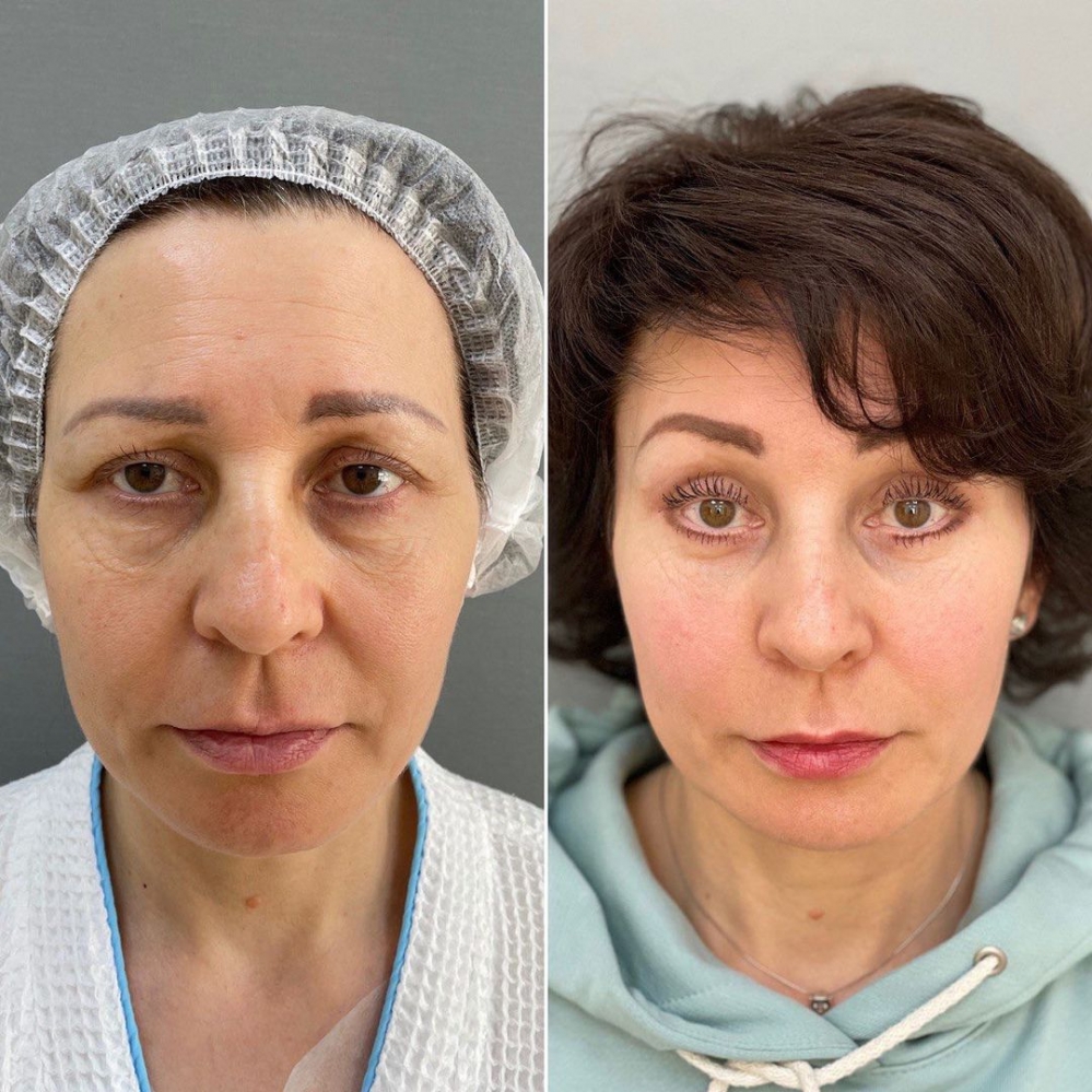 Эндоскопическая периорбитопластика