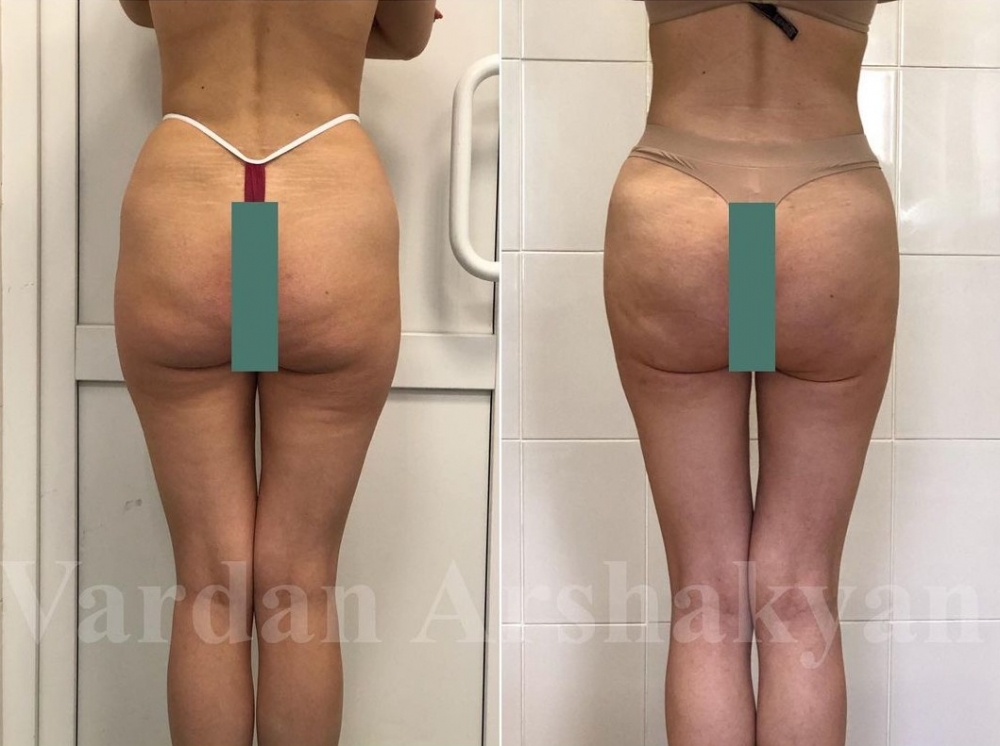 Пациентка Вардана Аршакяна до и после скульптурирования тела BodyTite