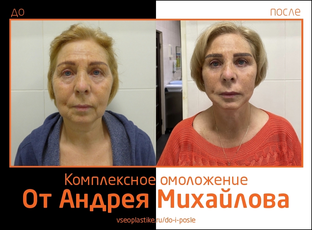 Андрей Михайлов. Фото до и после комплексного омоложения
