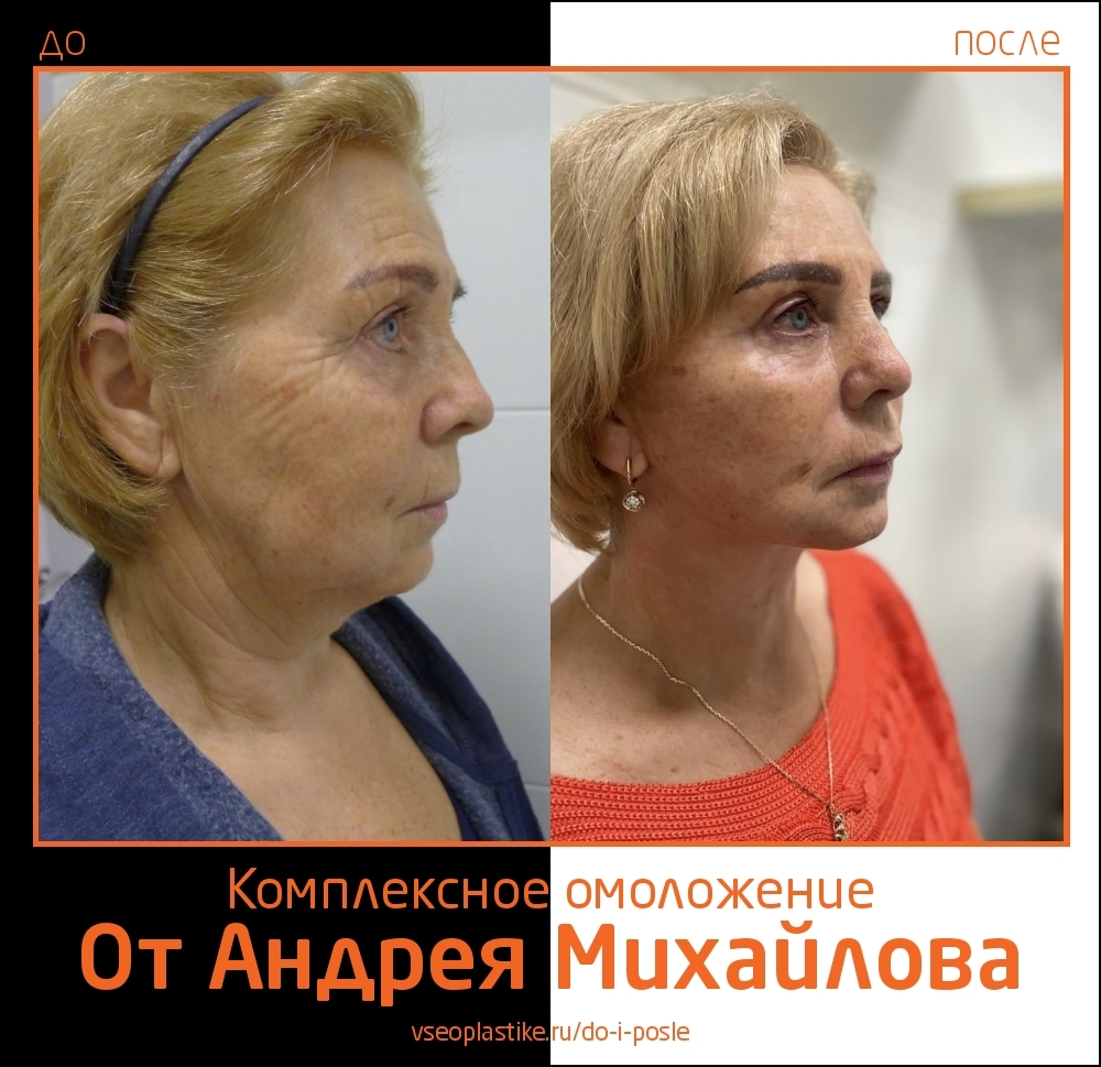 Пациентка доктора Михайлова до и после комплексного омоложения лица