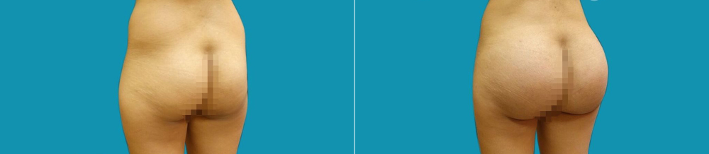 Пациентка доктора Гукаса Миракяна до и после увеличения ягодиц имплантами