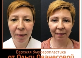  Ольга Ованесова. Фото до и после верхней блефаропластики
