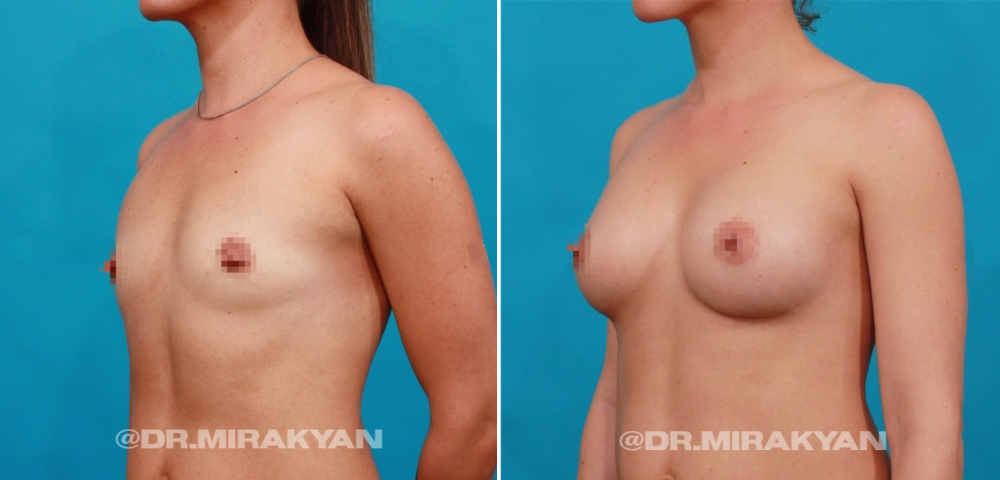 Пациентка до и после увеличения груди у доктора Гукаса Миракяна