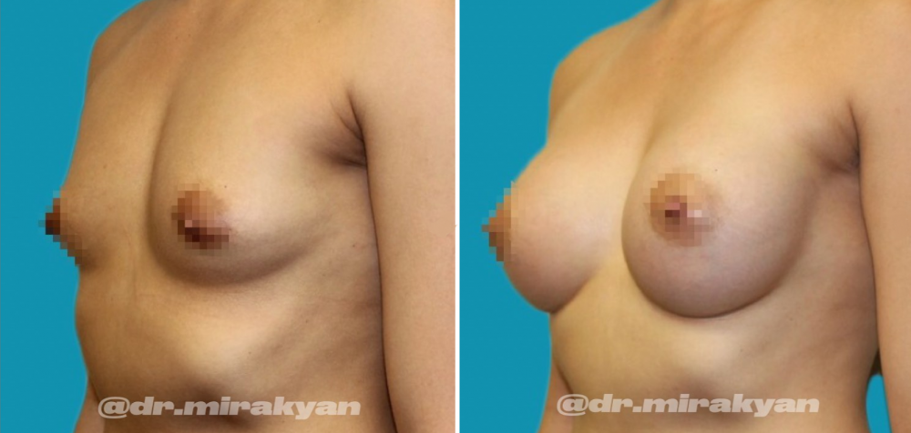 Пациентка до и после увеличения груди у доктора Гукаса Миракяна