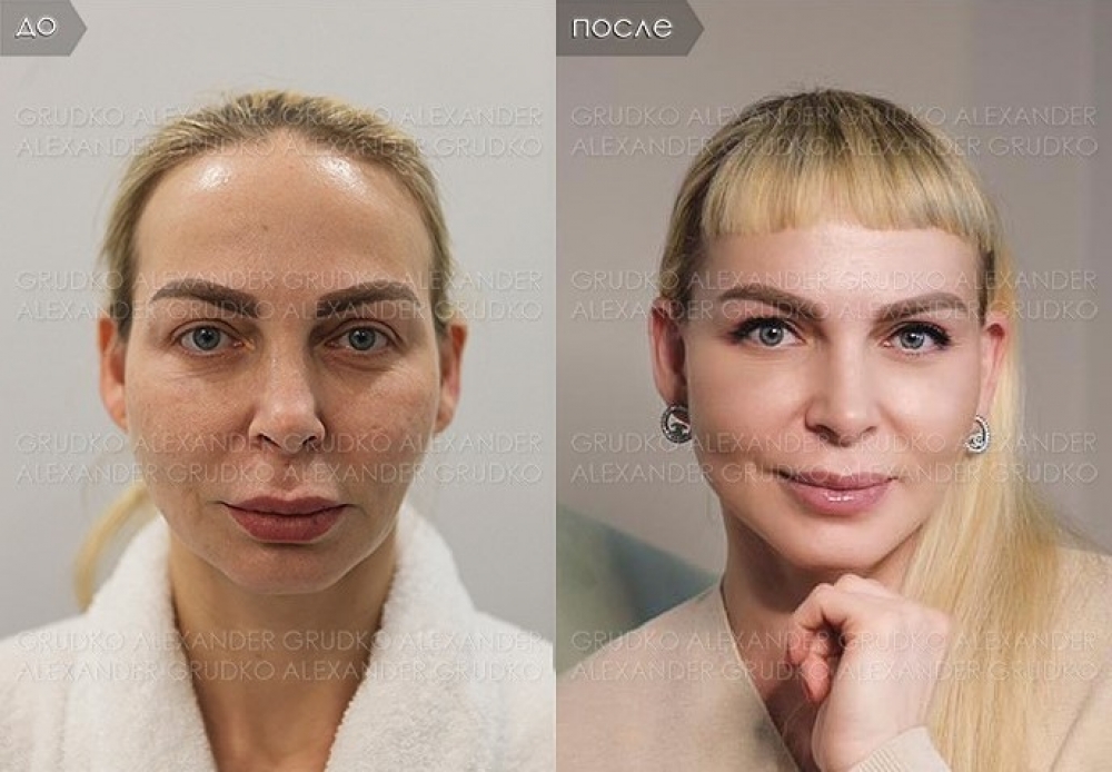 Пациентка доктора Грудько до и после имиджевой операции