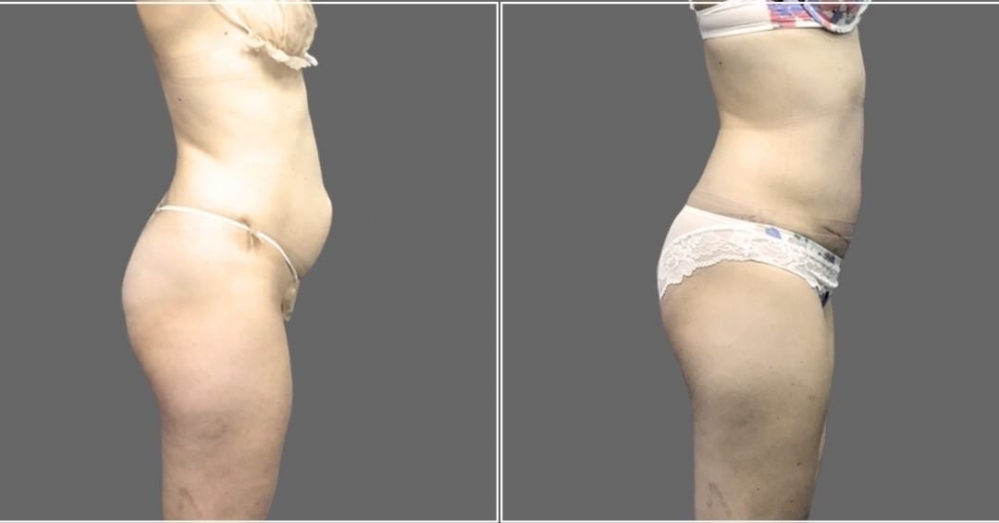 2 Пациентка доктора Дмитрия Рябцева до и после абдоминопластики