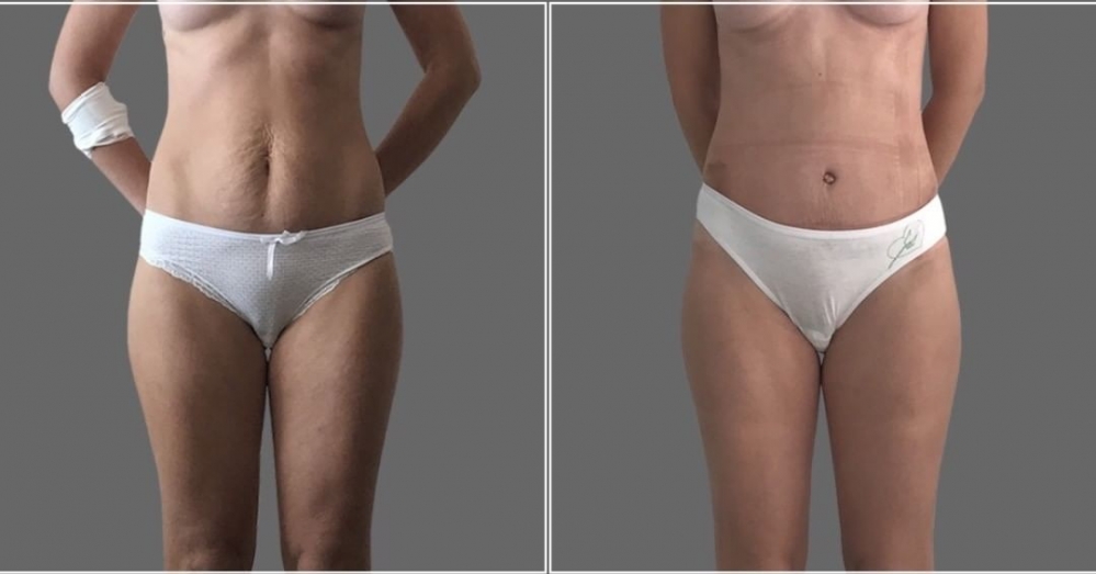 Абдоминопластика Дмитрий Рябцев