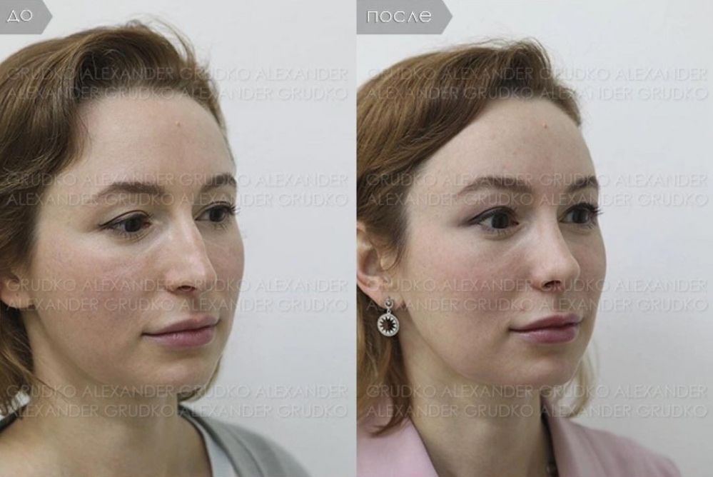 Фото пациентки доктора Грудько до и после имиджевой операции