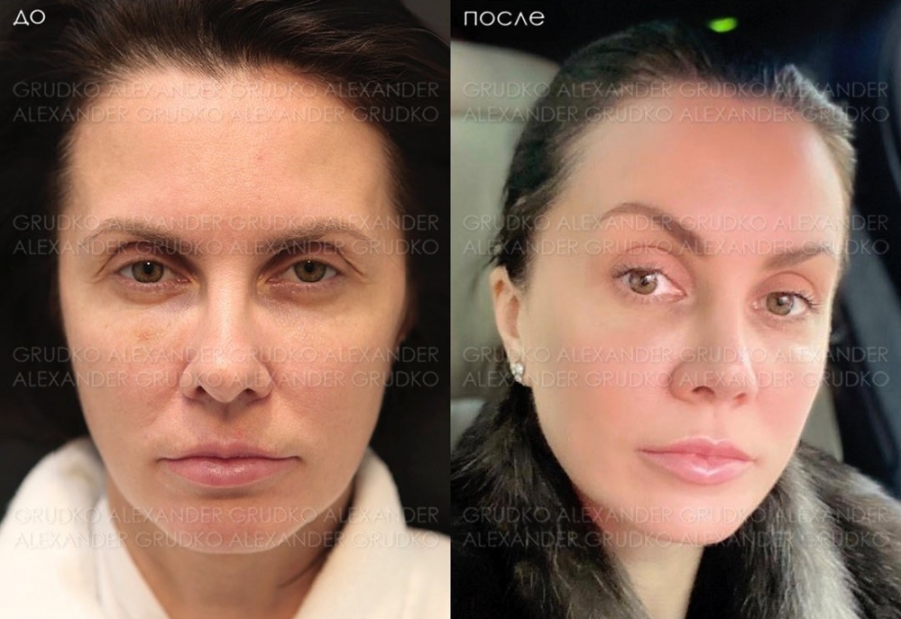 Пациентка доктора Грудько до и после имиджевой операции