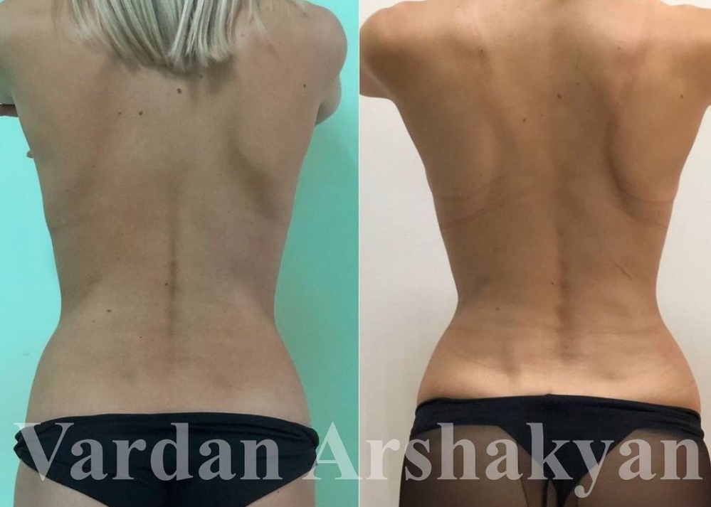 Пациентка доктора Вардана Аршакяна до и после операции по формированию узкой талии