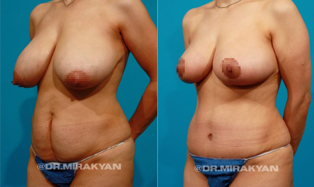 Пациентка Гукаса Миракяна до и после пластики живота и груди