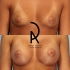 Пациентка пластического хирурга Амрама Пайтяна до и после увеличения груди