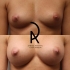 Пациентка пластического хирурга Амрама Пайтяна до и после увеличения груди
