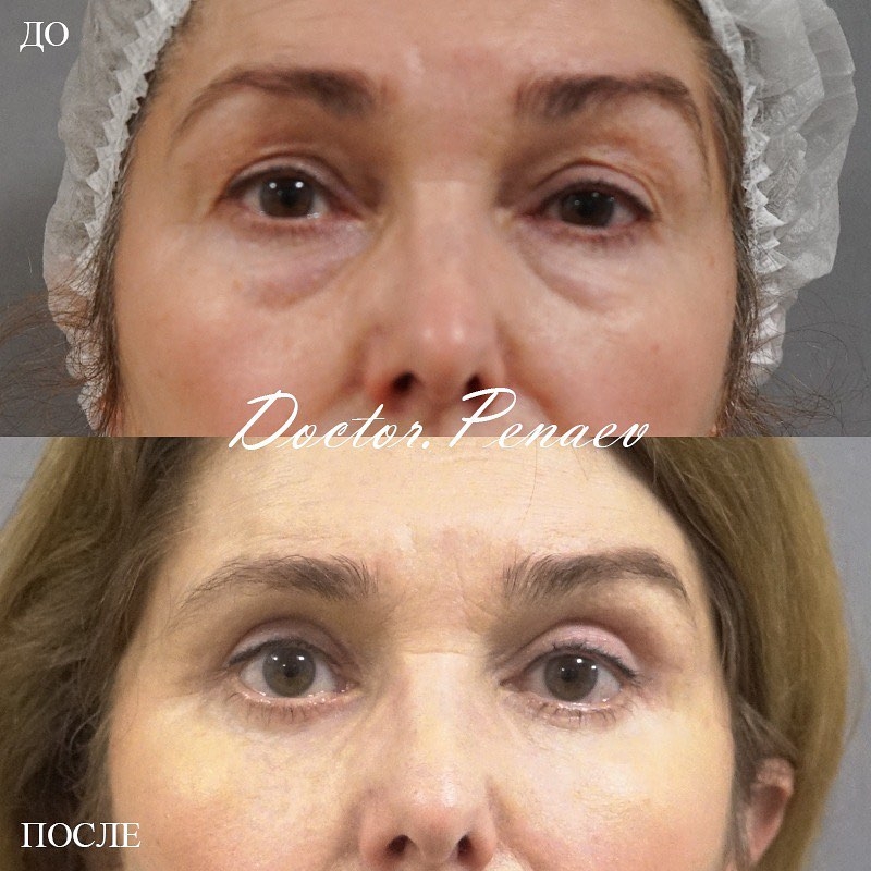 Пациентка доктора Арслана Пенаева до и после круговой блефаропластики