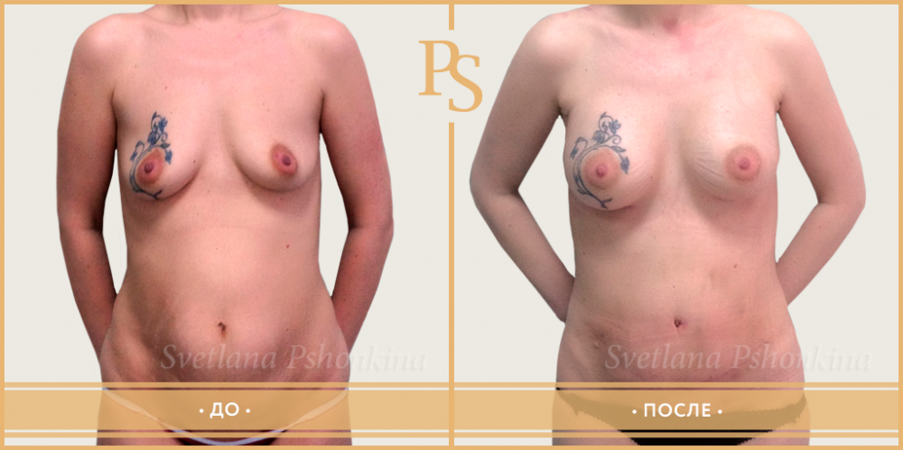 Пациентка пластического хирурга Светланы Пшонкиной до и после комплексной операции