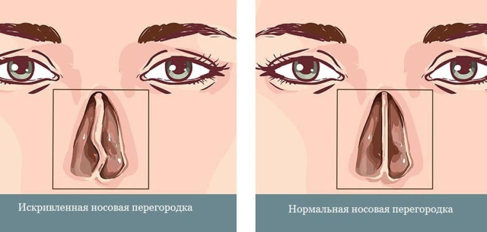 Искривленная и ровная носовая перегородка