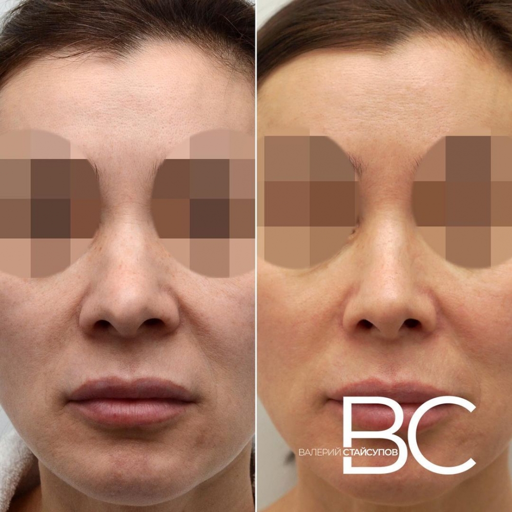 Пациентка пластического хирурга Валерия Стайсупова до и после закрытой ринопластики.