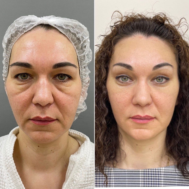 Пациентка доктора Марины Четвериковой до и после омоложения век и лица