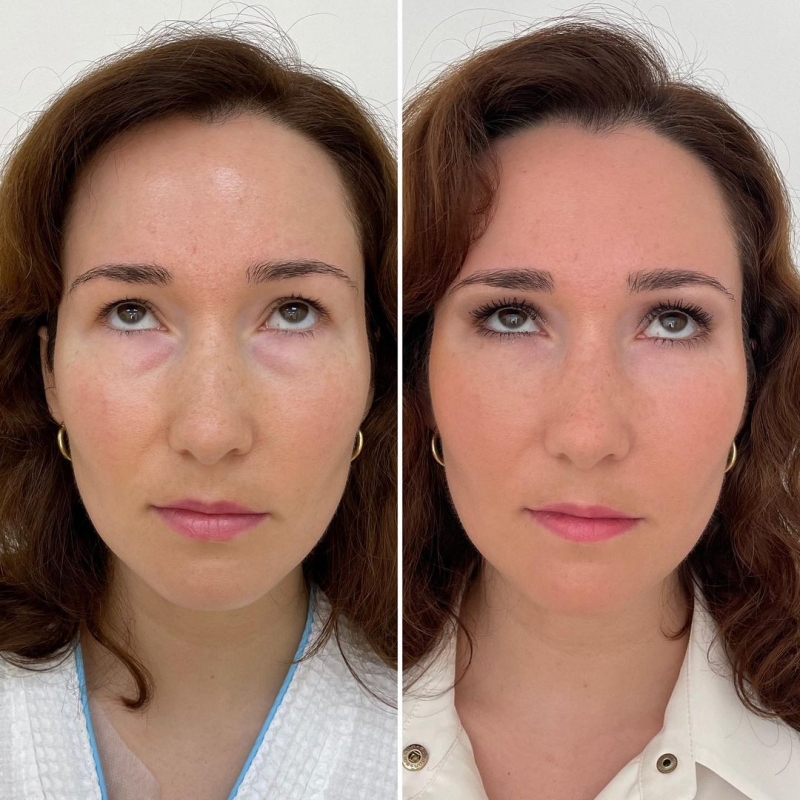 Пациентка доктора Марины Четвериковой до и после нижней трансконъюнктивальной блефаропластики