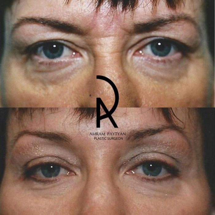Пациентка доктора Амрама Пайтяна до и после верхней блефаропластики