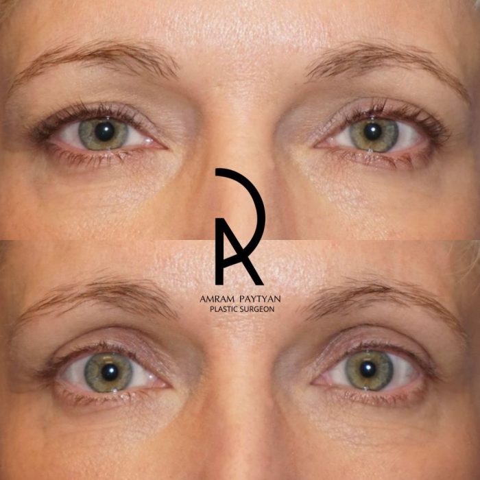 Пациентка доктора Амрама Пайтяна до и после верхней блефаропластики