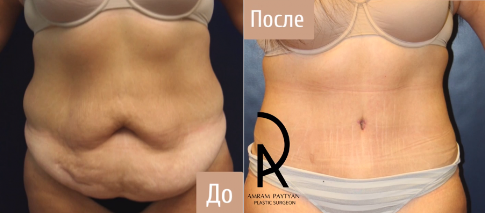 Пациентка (36 лет) доктора Амрама Пайтяна до и после абдоминопластики